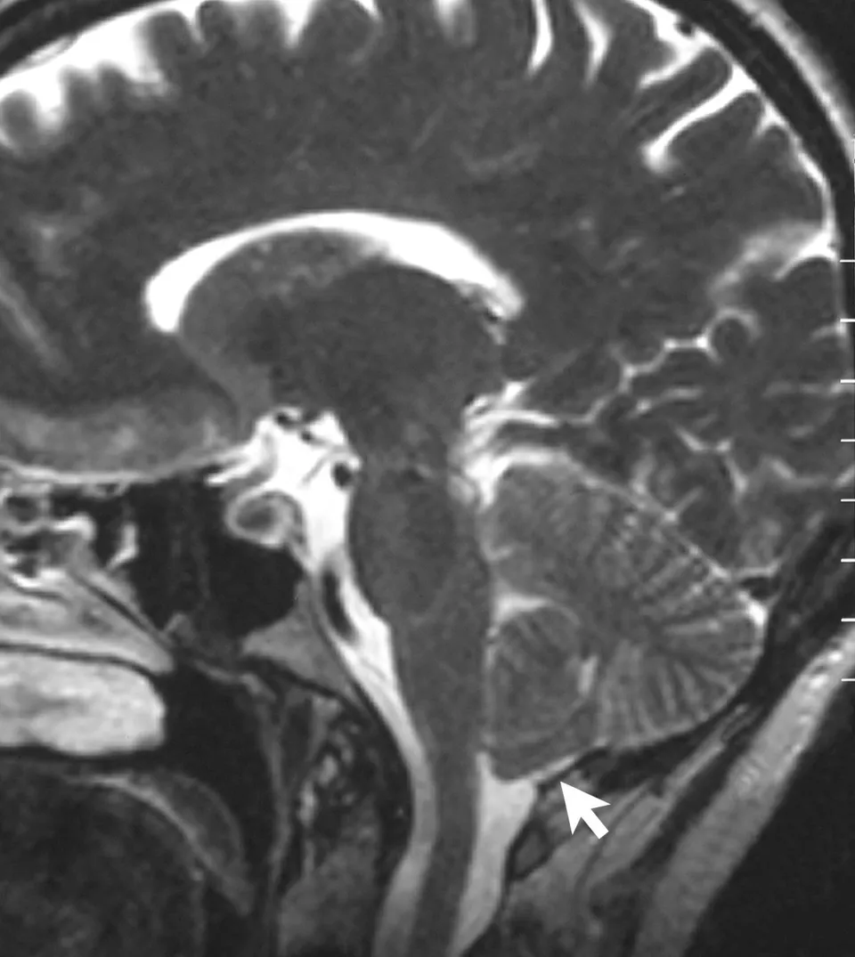 Image d'IRM cérébrale en coupe sagittale