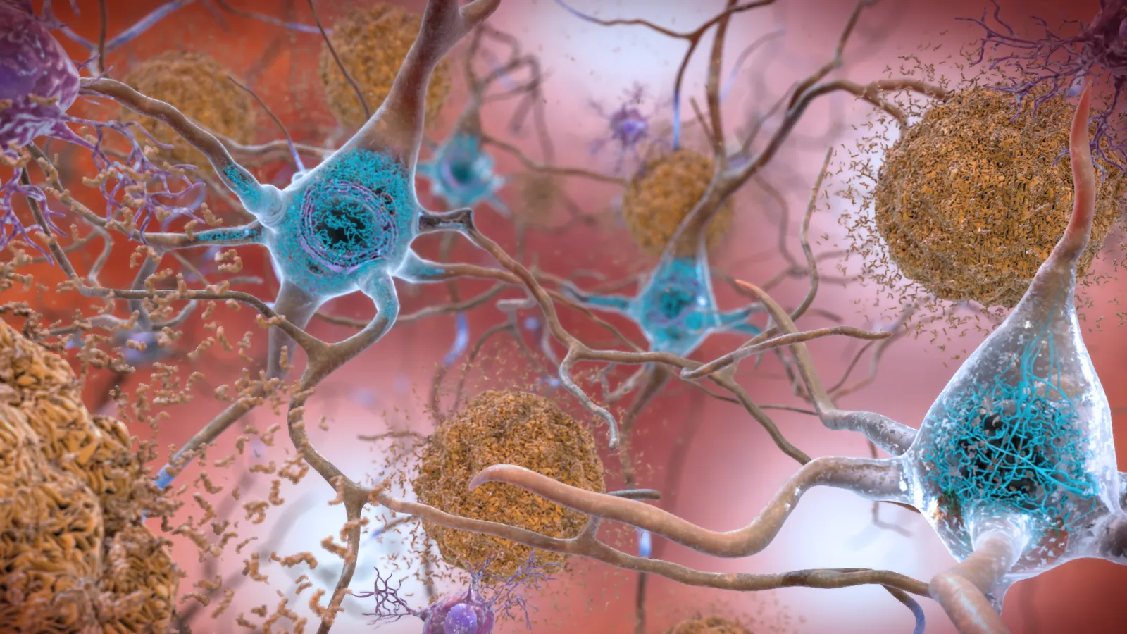 Illustration des plaques bêta-amyloïdes et de la protéine tau dans le cerveau